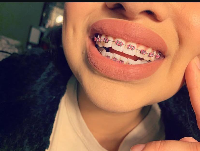 Removable Pink Braces - Modern and chic